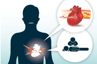 Heart attack (acute myocardial infarction)