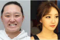 렛미인4 김진, 심각한 안면비대칭과 부정교합… 어땠길래?