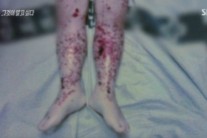 쉽게 고칠 병 옴, 방치하면 끔찍…“아동학대일 것”