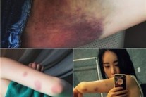 ‘성형 고백’ 홍수아, 피멍든 사진 공개 … “이소룡 되는중”