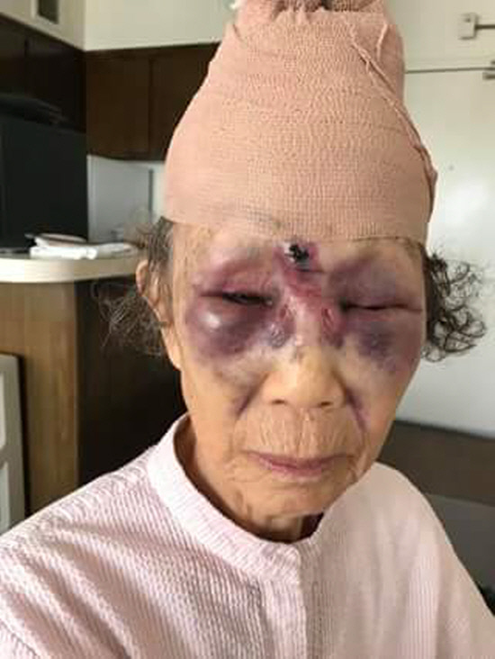 묻지마 폭행 피해 여성