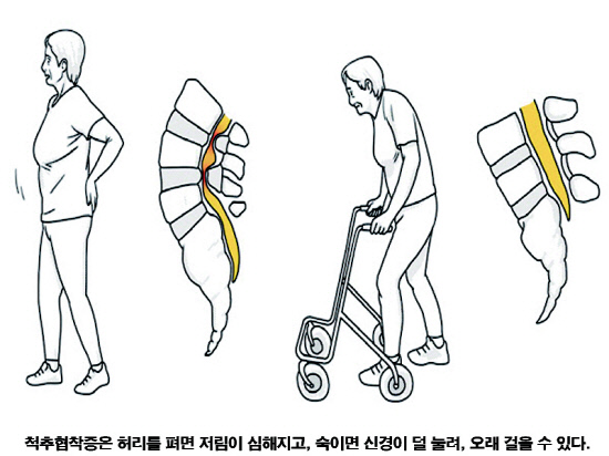 척추협착증 사진(800600)