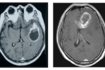 [김태열의 생생건강S펜] “뇌종양, 대부분은 죽을병 아냐..미리 겁먹지마세요”