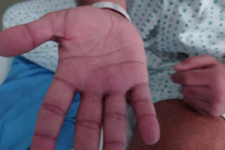 “최악의 질병, 사망자 201명…’아시아에서 ‘엠폭스 새 변종’ 발견됐다