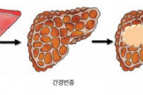 [김태열의 생생건강S펜] “팔팔했던 당신의 간, 혹사하면 서서히 망가집니다”
