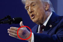 ‘건강이상설’ 트럼프 손등에 심각한 멍 사진 확산…해명 봤더니