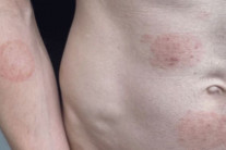 “성관계 자제를” 미네소타州 ‘역대 최대 발병’ 희귀 곰팡이 감염병 주의보