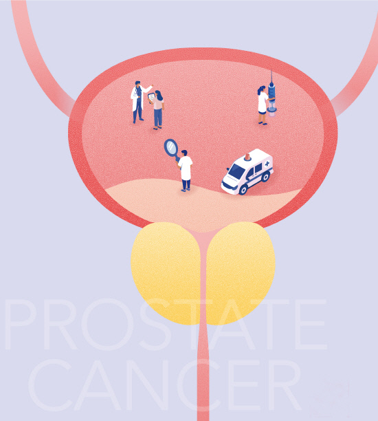 전립선암 사진