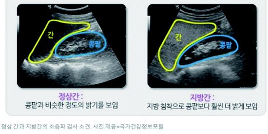 정상간 지방간(800400)